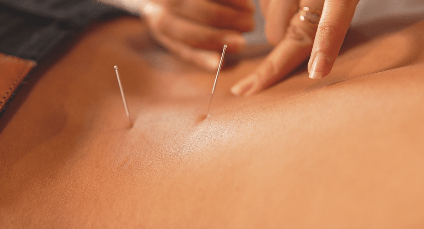 Unlocking Your Body’s Natural Healing Power with Acupuncture